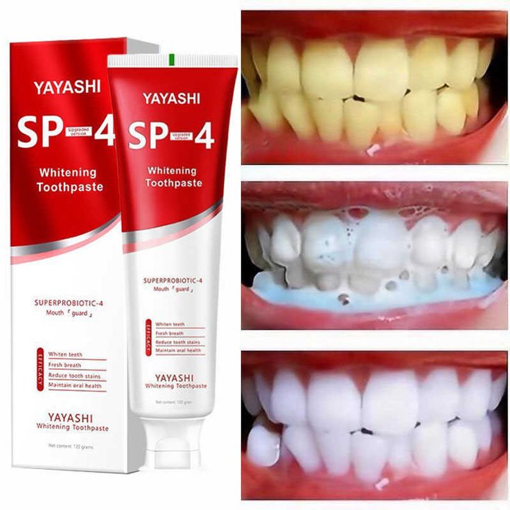 Transformez votre sourire dès aujourd’hui avec SP-4 Ultra+ – La solution avancée pour des dents visiblement plus blanches